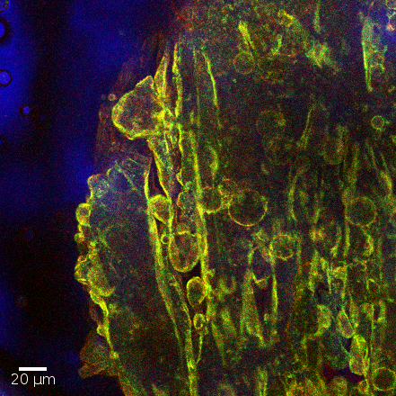 A glycerol-in-oil emulsion has decomposed into a single coalesced glycerol drop (right), but the incompressible particle-laden interface reacts by buckling into ripples and droplets.  The image was produced via fluorescence confocal microscopy, with nanoparticles shown as green and glycerol as red; the optical transmission channel is overlaid in blue.